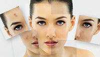 Tratamento para Acne