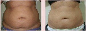 lipo-antes-depois